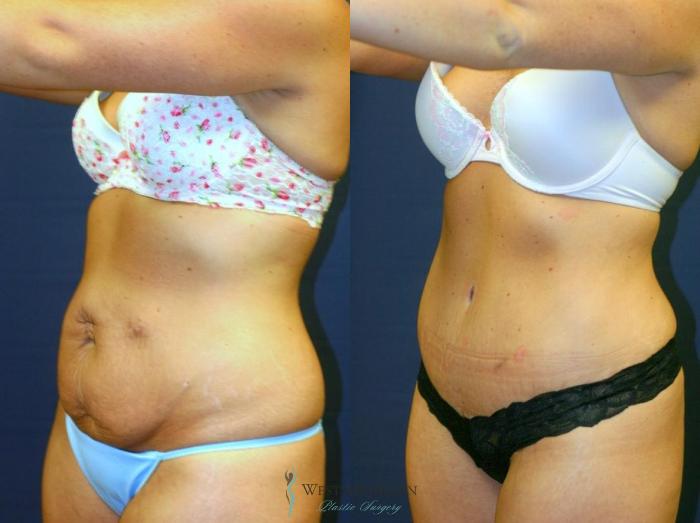 Before & After Tummy Tuck Case 8973 View #3 View in Kalamazoo & Grand Rapids, Michigan