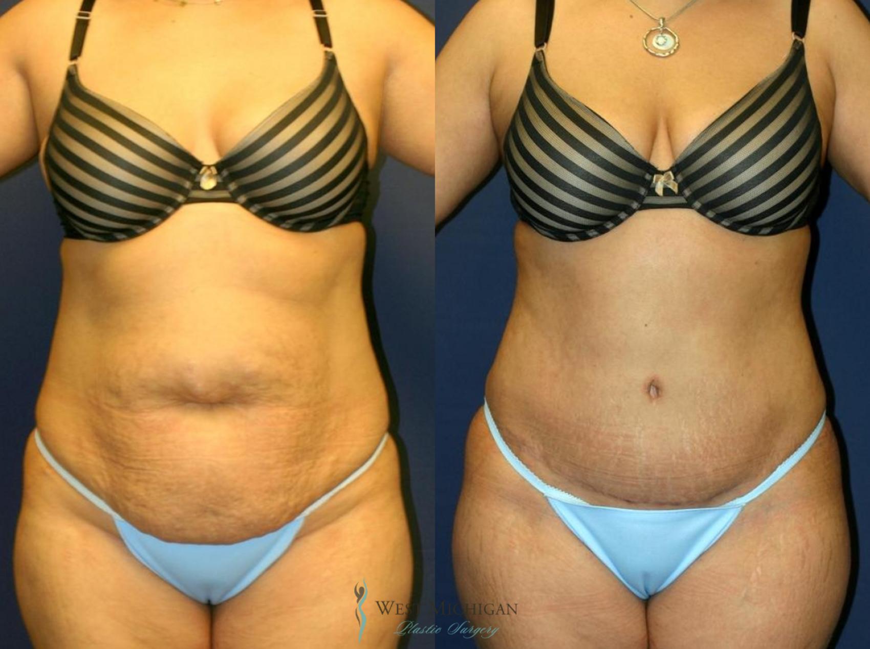 Before & After Tummy Tuck Case 9013 View #1 View in Kalamazoo & Grand Rapids, Michigan