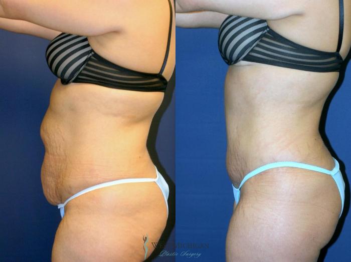 Before & After Tummy Tuck Case 9013 View #2 View in Kalamazoo & Grand Rapids, Michigan
