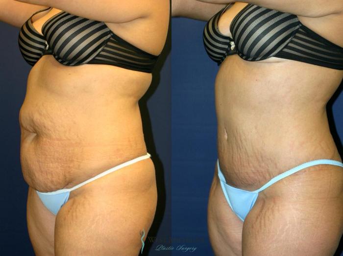 Before & After Tummy Tuck Case 9013 View #3 View in Kalamazoo & Grand Rapids, Michigan
