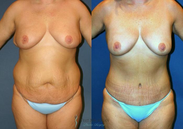 Before & After Tummy Tuck Case 9025 View #1 View in Portage, Kalamazoo, Battle Creek, Michigan