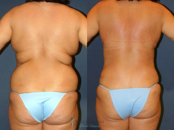 Before & After Tummy Tuck Case 9025 View #2 View in Portage, Kalamazoo, Battle Creek, Michigan