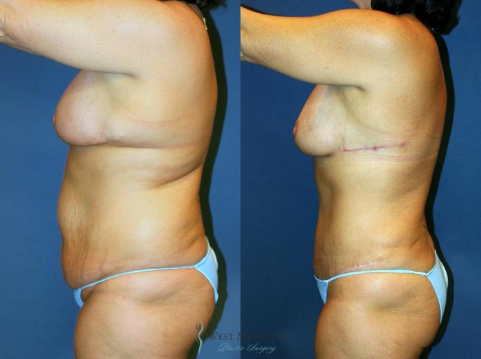 Before & After Tummy Tuck Case 9025 View #3 View in Portage, Kalamazoo, Battle Creek, Michigan