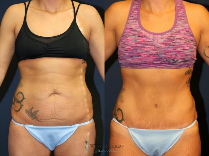 Before & After Tummy Tuck Case 9048 View #1 View in Kalamazoo & Grand Rapids, Michigan