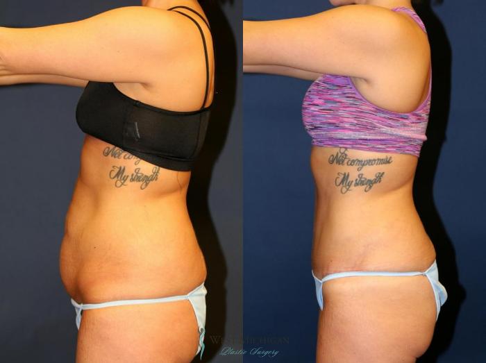 Before & After Tummy Tuck Case 9048 View #2 View in Kalamazoo & Grand Rapids, Michigan