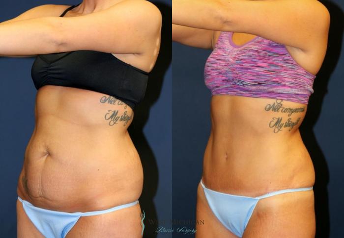Before & After Tummy Tuck Case 9048 View #3 View in Kalamazoo & Grand Rapids, Michigan