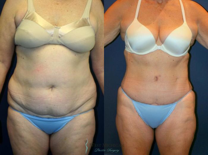 Before & After Tummy Tuck Case 9049 View #1 View in Kalamazoo & Grand Rapids, Michigan
