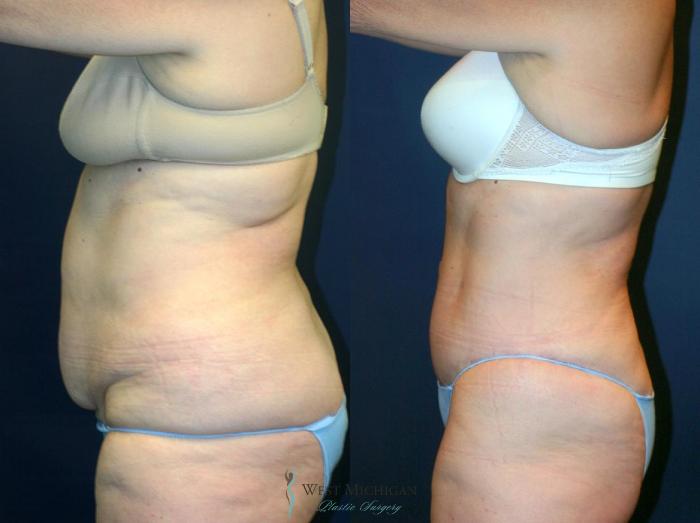 Before & After Tummy Tuck Case 9049 View #2 View in Kalamazoo & Grand Rapids, Michigan