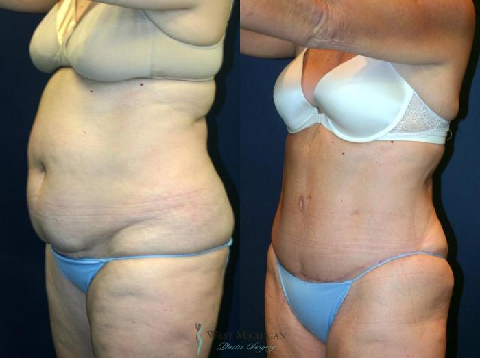 Before & After Tummy Tuck Case 9049 View #3 View in Kalamazoo & Grand Rapids, Michigan