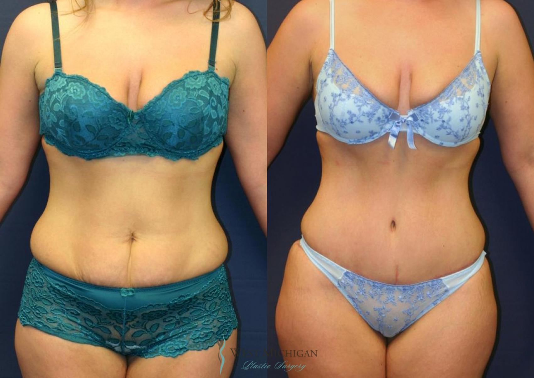 Before & After Tummy Tuck Case 9050 View #1 View in Kalamazoo & Grand Rapids, Michigan