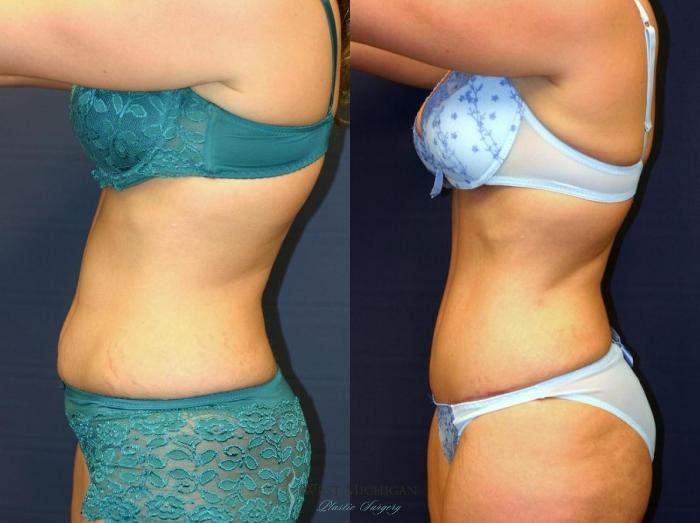 Before & After Tummy Tuck Case 9050 View #2 View in Kalamazoo & Grand Rapids, Michigan