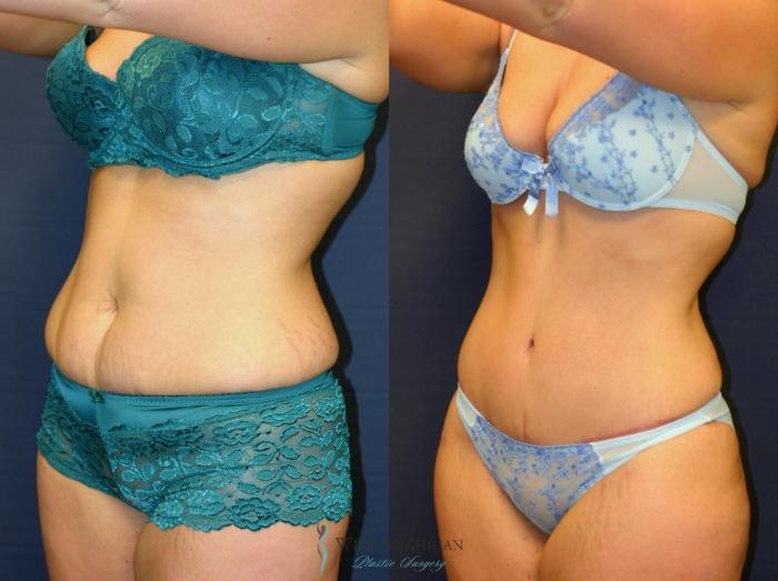 Before & After Tummy Tuck Case 9050 View #3 View in Kalamazoo & Grand Rapids, Michigan
