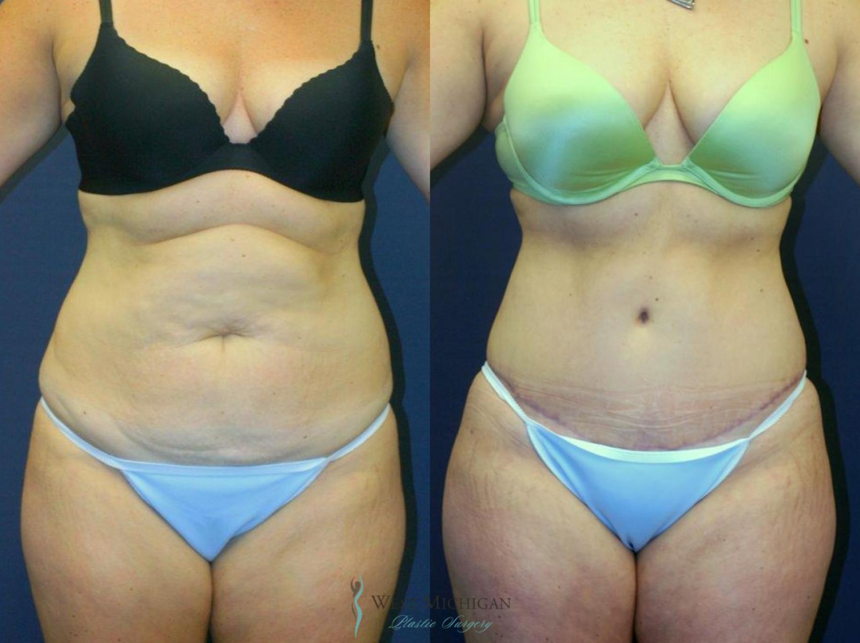 Before & After Tummy Tuck Case 9051 View #1 View in Kalamazoo & Grand Rapids, Michigan