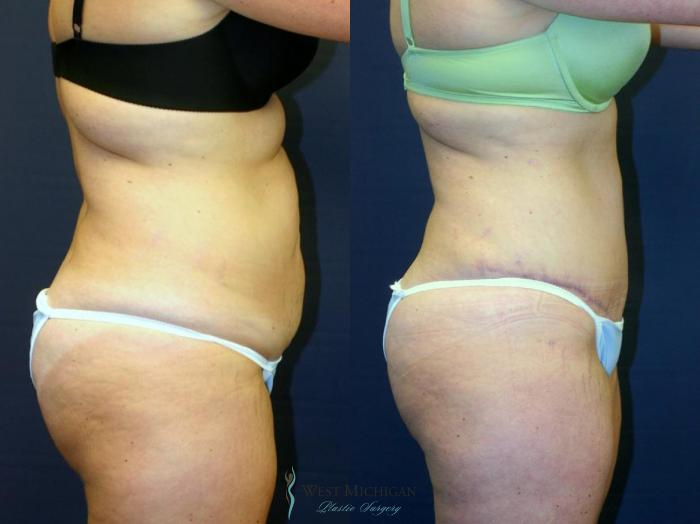 Before & After Tummy Tuck Case 9051 View #2 View in Kalamazoo & Grand Rapids, Michigan