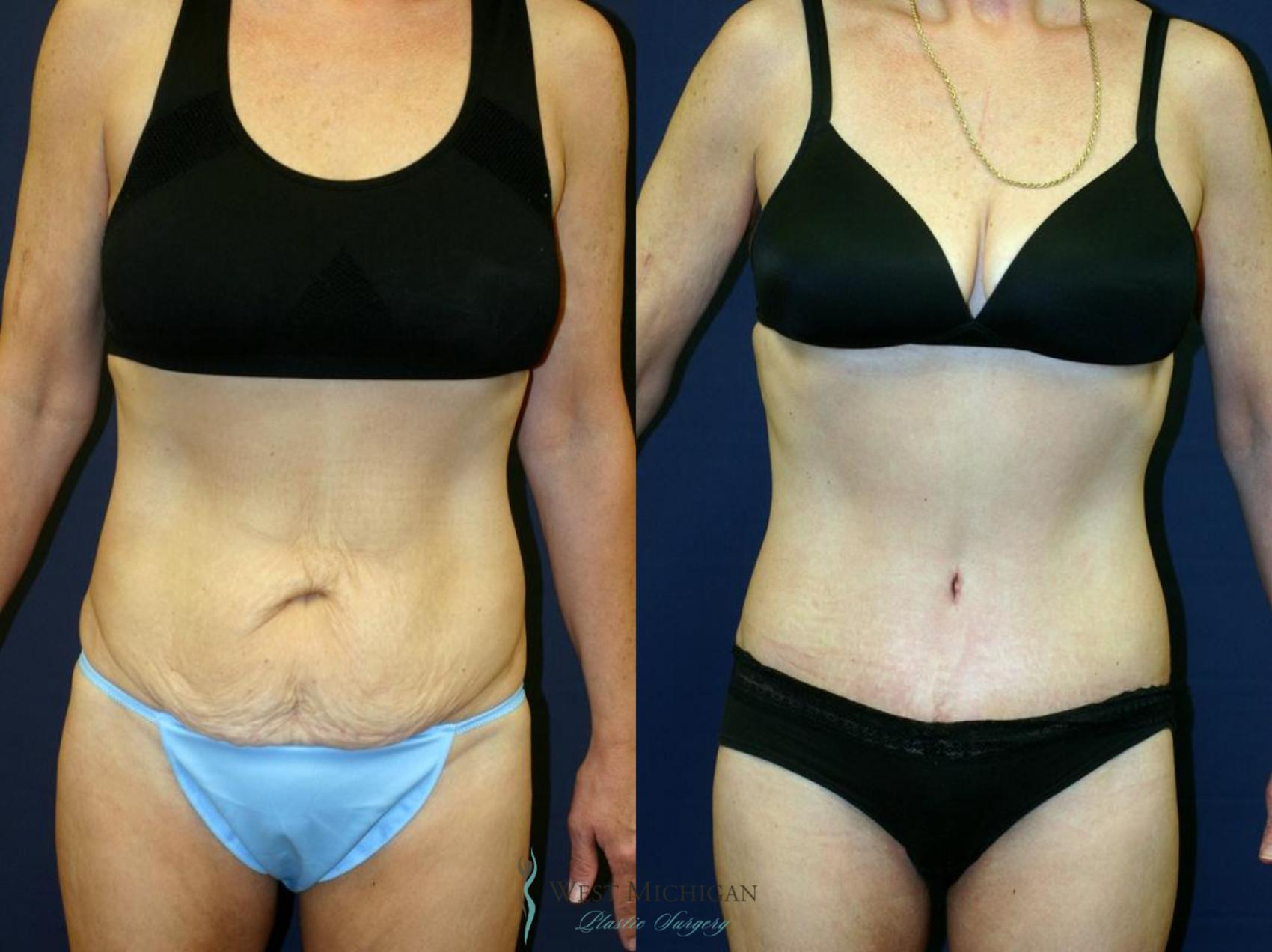 Before & After Tummy Tuck Case 9052 View #1 View in Kalamazoo & Grand Rapids, Michigan