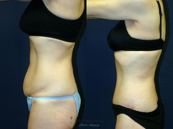 Before & After Tummy Tuck Case 9052 View #2 View in Kalamazoo & Grand Rapids, Michigan