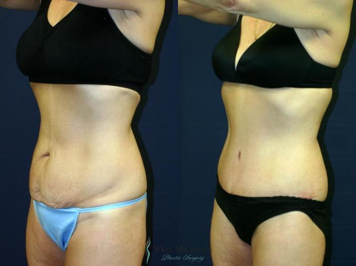 Before & After Tummy Tuck Case 9052 View #3 View in Kalamazoo & Grand Rapids, Michigan