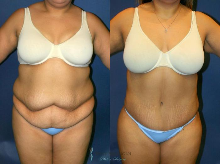 Before & After Tummy Tuck Case 9053 View #1 View in Portage, Kalamazoo, Battle Creek, Michigan