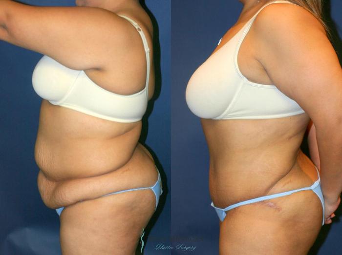 Before & After Tummy Tuck Case 9053 View #2 View in Portage, Kalamazoo, Battle Creek, Michigan
