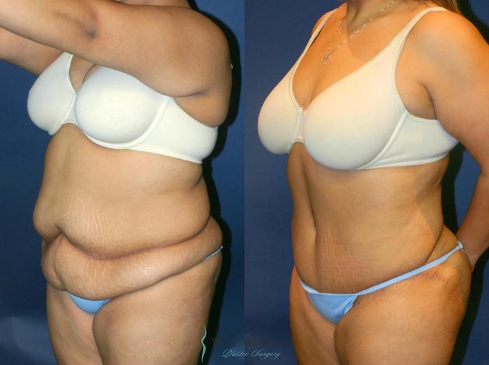 Before & After Tummy Tuck Case 9053 View #3 View in Portage, Kalamazoo, Battle Creek, Michigan