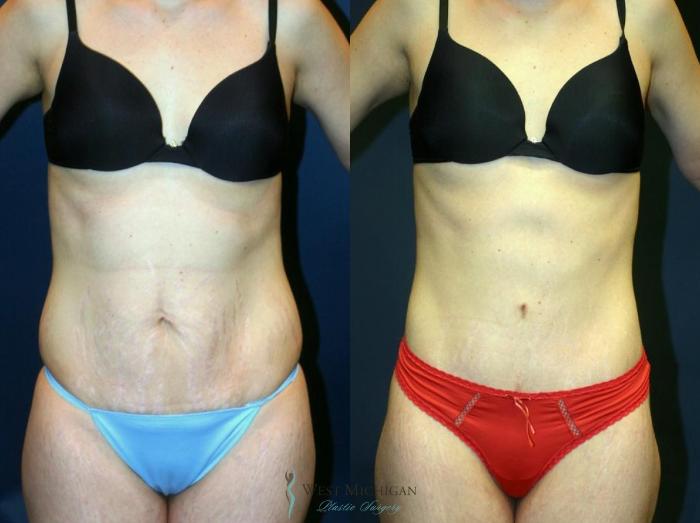 Before & After Tummy Tuck Case 9054 View #1 View in Kalamazoo & Grand Rapids, Michigan