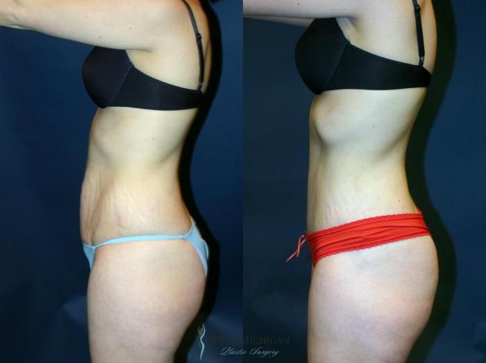 Before & After Tummy Tuck Case 9054 View #2 View in Kalamazoo & Grand Rapids, Michigan