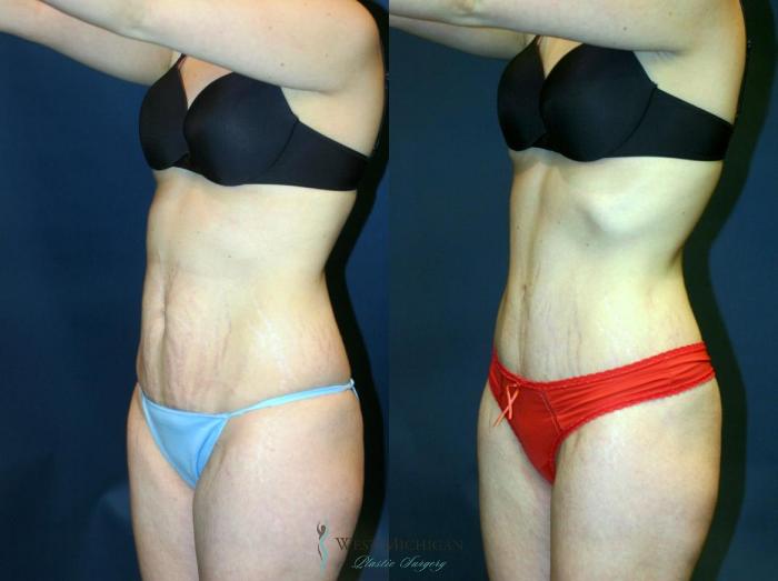 Before & After Tummy Tuck Case 9054 View #3 View in Kalamazoo & Grand Rapids, Michigan