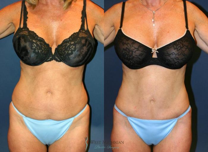 Before & After Tummy Tuck Case 9055 View #1 View in Kalamazoo & Grand Rapids, Michigan