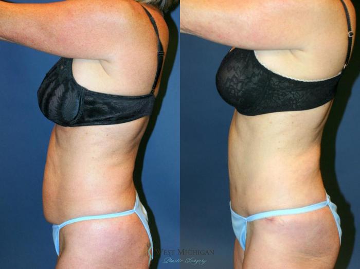 Before & After Tummy Tuck Case 9055 View #2 View in Kalamazoo & Grand Rapids, Michigan