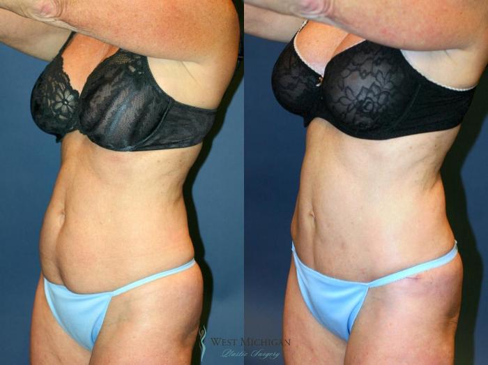 Before & After Tummy Tuck Case 9055 View #3 View in Kalamazoo & Grand Rapids, Michigan
