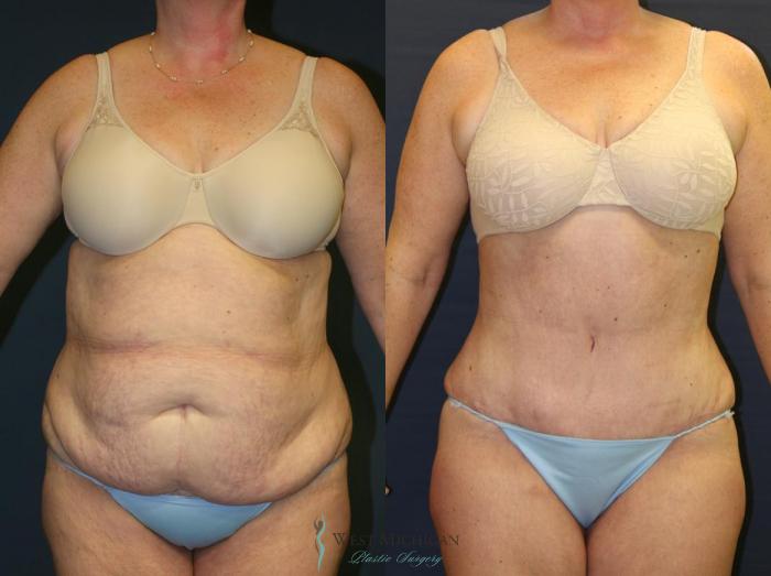 Before & After Tummy Tuck Case 9056 View #1 View in Portage, Kalamazoo, Battle Creek, Michigan
