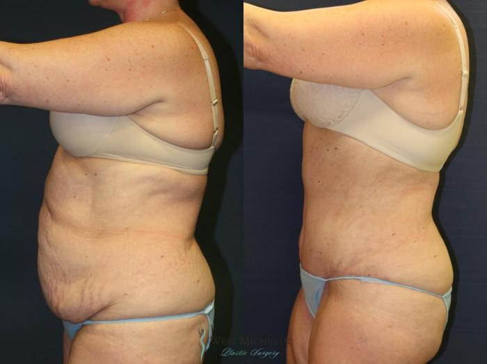 Before & After Tummy Tuck Case 9056 View #2 View in Kalamazoo & Grand Rapids, Michigan