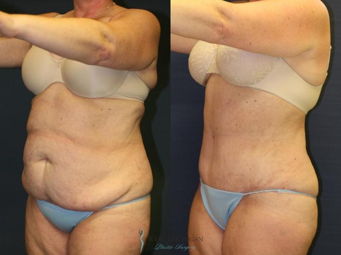 Before & After Tummy Tuck Case 9056 View #3 View in Kalamazoo & Grand Rapids, Michigan