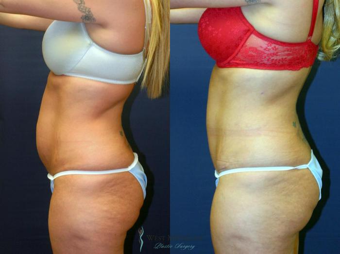 Before & After Tummy Tuck Case 9057 View #2 View in Portage, Kalamazoo, Battle Creek, Michigan