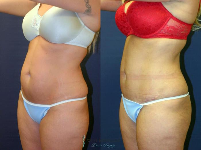Before & After Tummy Tuck Case 9057 View #3 View in Portage, Kalamazoo, Battle Creek, Michigan