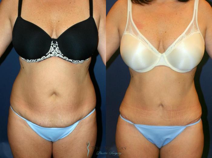 Before & After Tummy Tuck Case 9058 View #1 View in Portage, Kalamazoo, Battle Creek, Michigan