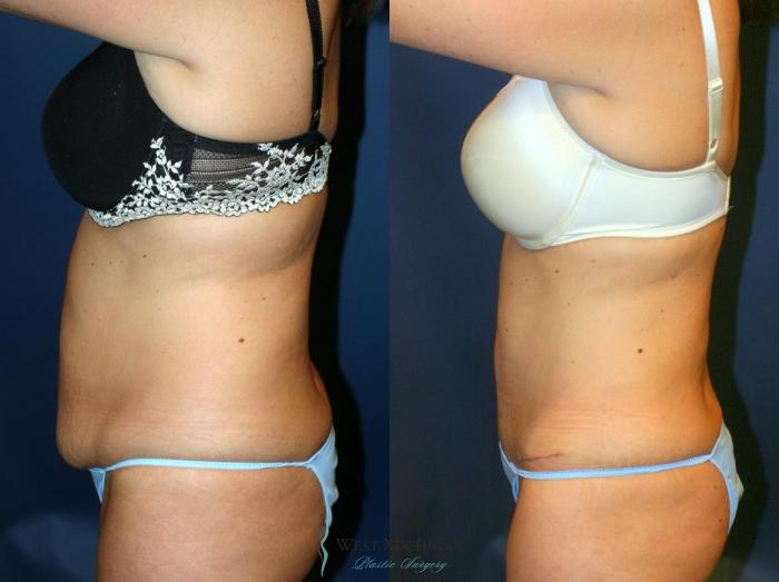 Before & After Tummy Tuck Case 9058 View #2 View in Portage, Kalamazoo, Battle Creek, Michigan