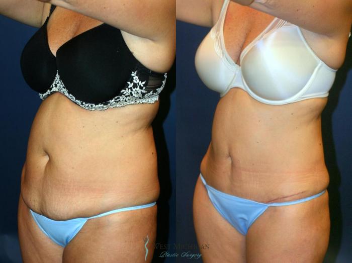 Before & After Tummy Tuck Case 9058 View #3 View in Portage, Kalamazoo, Battle Creek, Michigan