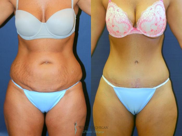 Before & After Tummy Tuck Case 9059 View #1 View in Kalamazoo & Grand Rapids, Michigan