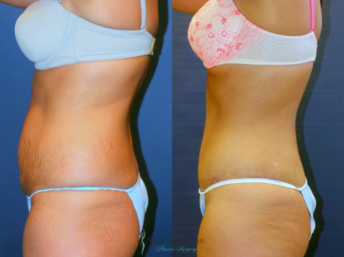 Before & After Tummy Tuck Case 9059 View #2 View in Kalamazoo & Grand Rapids, Michigan