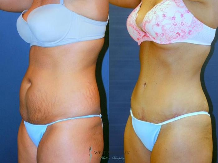 Before & After Tummy Tuck Case 9059 View #3 View in Kalamazoo & Grand Rapids, Michigan