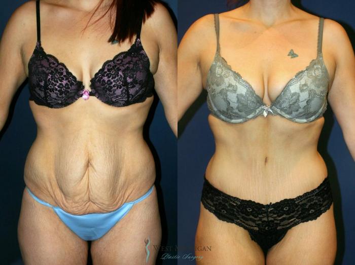 Before & After Tummy Tuck Case 9060 View #1 View in Portage, Kalamazoo, Battle Creek, Michigan
