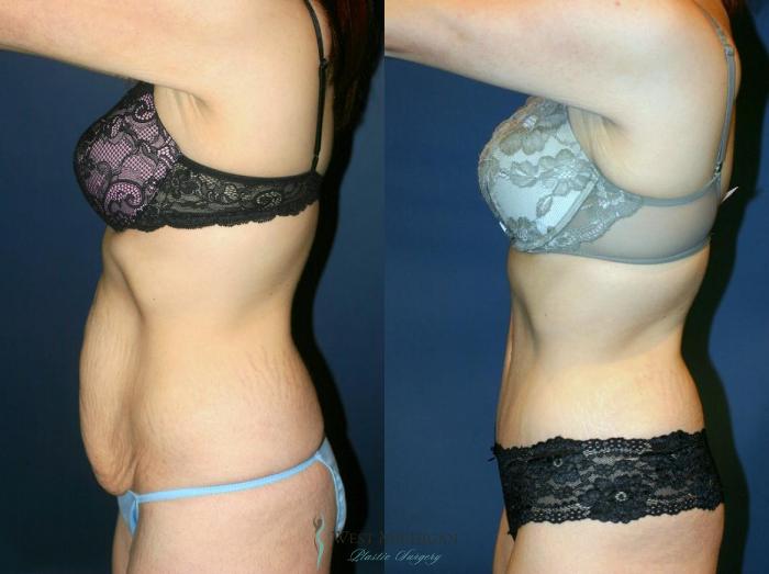 Before & After Tummy Tuck Case 9060 View #2 View in Portage, Kalamazoo, Battle Creek, Michigan