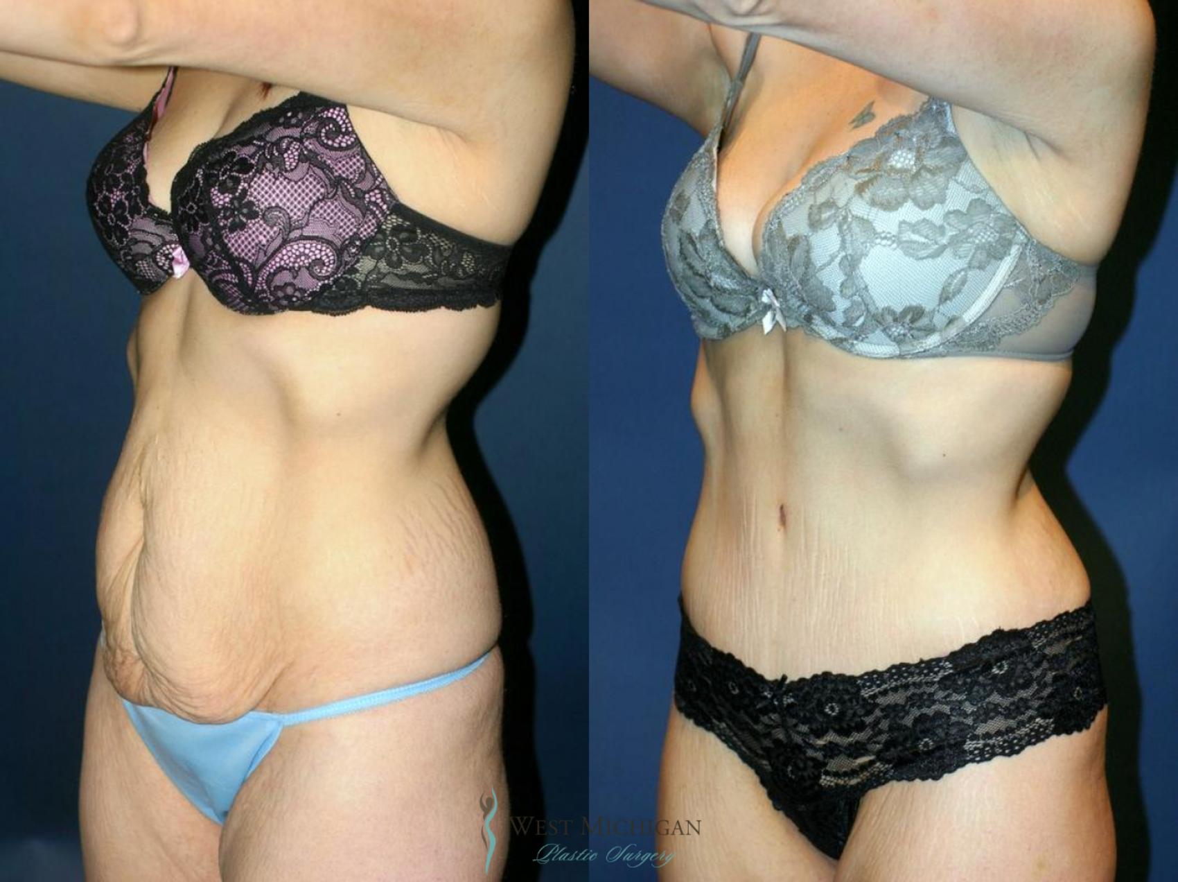 Before & After Tummy Tuck Case 9060 View #3 View in Kalamazoo & Grand Rapids, Michigan