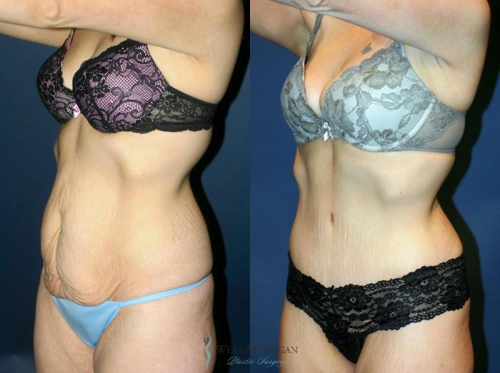 Before & After Tummy Tuck Case 9060 View #3 View in Portage, Kalamazoo, Battle Creek, Michigan