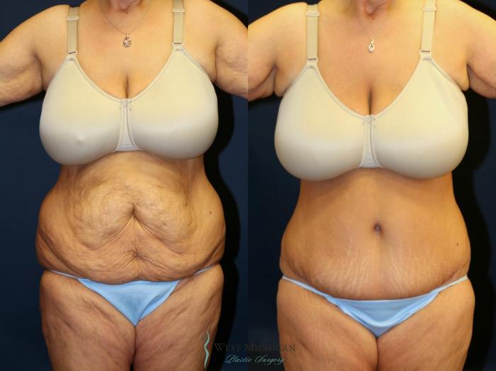 Before & After Tummy Tuck Case 9061 View #1 View in Kalamazoo & Grand Rapids, Michigan