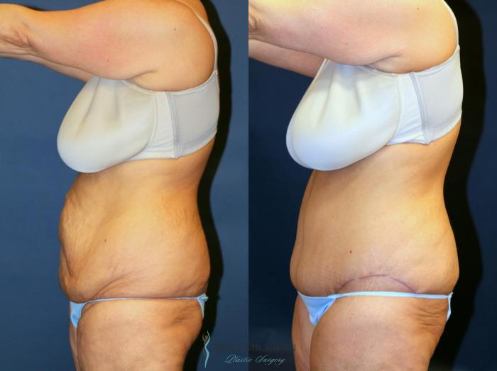Before & After Tummy Tuck Case 9061 View #2 View in Kalamazoo & Grand Rapids, Michigan
