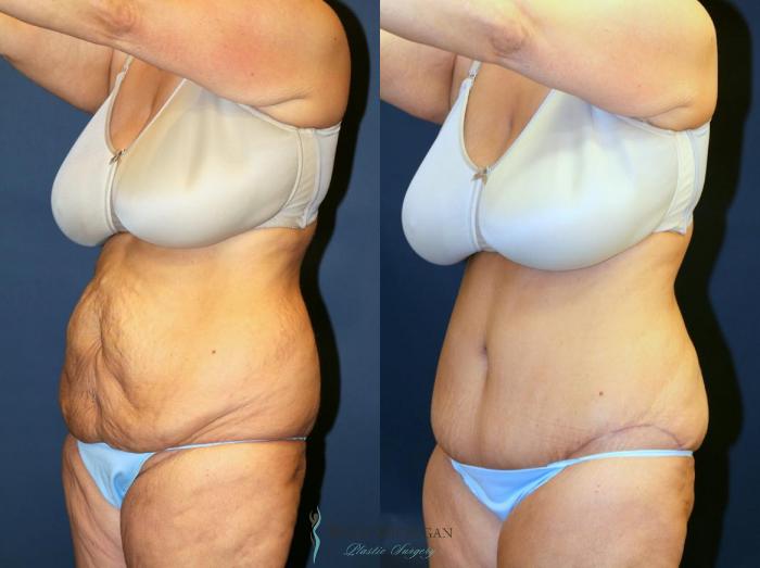 Before & After Tummy Tuck Case 9061 View #3 View in Kalamazoo & Grand Rapids, Michigan