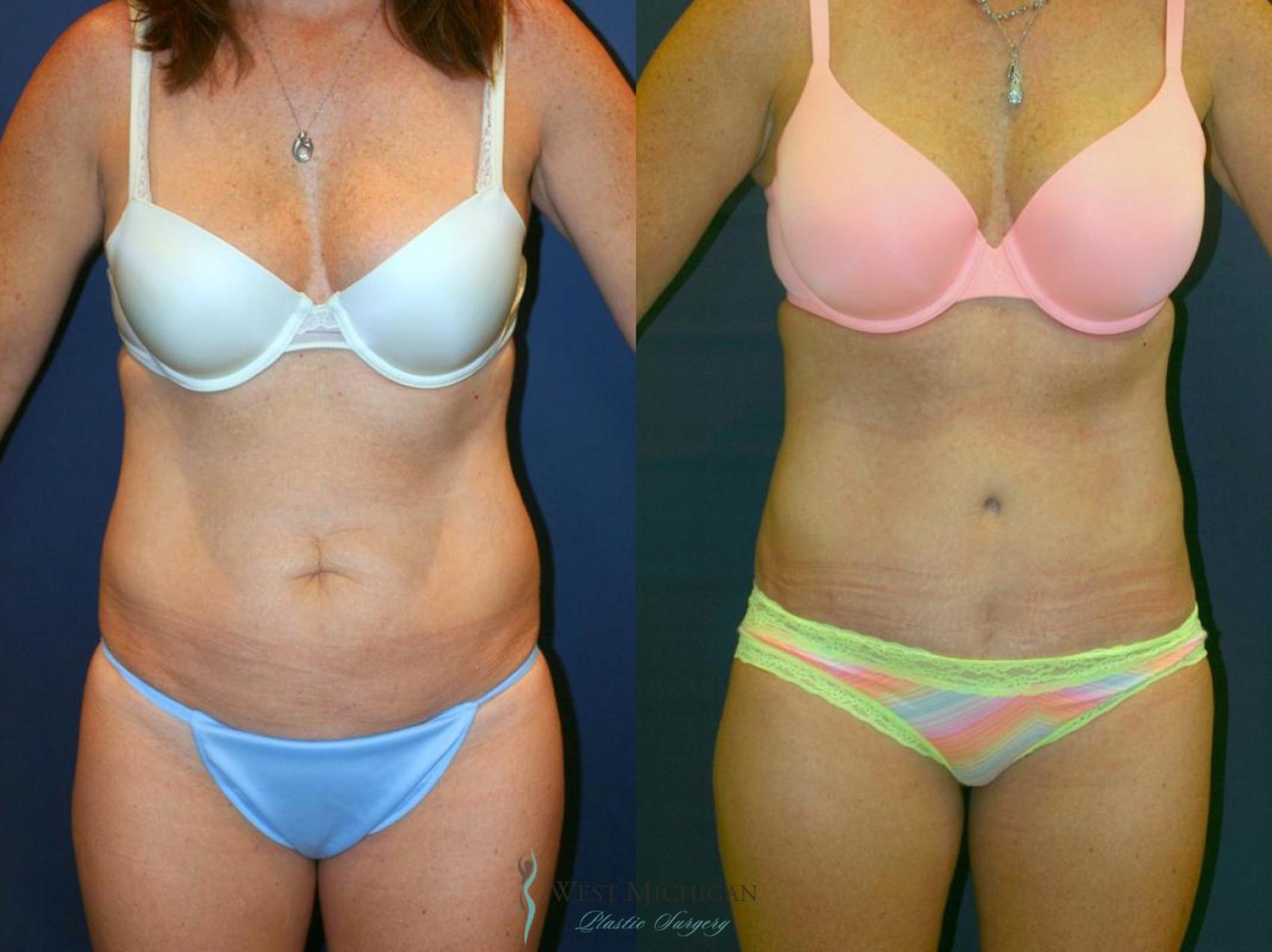 Before & After Tummy Tuck Case 9062 View #1 View in Kalamazoo & Grand Rapids, Michigan