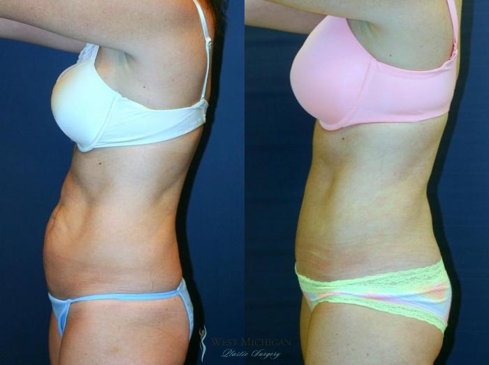 Before & After Tummy Tuck Case 9062 View #2 View in Kalamazoo & Grand Rapids, Michigan